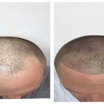 hair scalp treatment in Vadodara