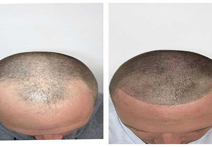 hair scalp treatment in Vadodara