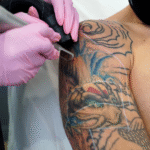 tattoo removal essex