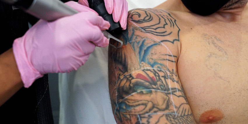 tattoo removal essex